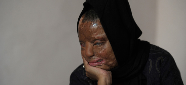 TO GO WITH India-women-crime-entertainment,FEATURE by Rupam Jain Nair 
In a picture taken on December 5, 2012, Indian acid attack survivor Sonali Mukherjee poses at her home in New Delhi. When Sonali Mukherjee rejected the advances of three of her fellow students, they responded by melting her face with acid. But rather than hide herself away, the 27-year-old applied to appear on India's most watched TV quiz show -- and walked away as a millionaire. AFP PHOTO/SAJJAD HUSSAIN (Photo credit should read SAJJAD HUSSAIN/AFP/Getty Images)