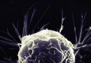 Prendere il cancro è solo sfortuna?