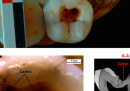 Il dente cariato curato 14mila anni fa