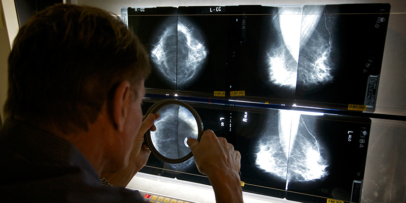 Analisi di alcune mammografie (AP Photo/Damian Dovarganes)