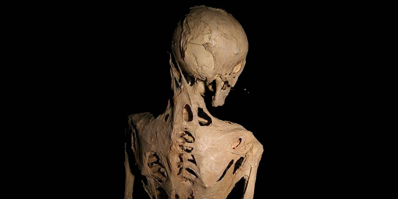 Lo scheletro di una persona affetta da fibrodisplasia ossificante progressiva (Wikimedia)