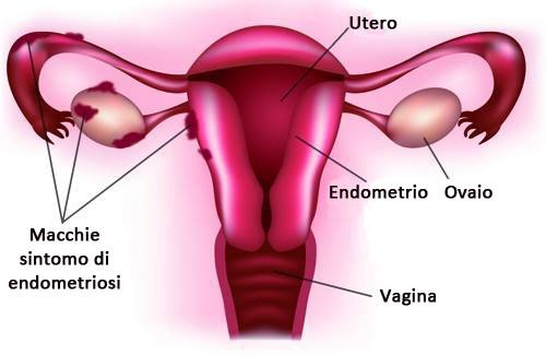 Endometriosi-500x325