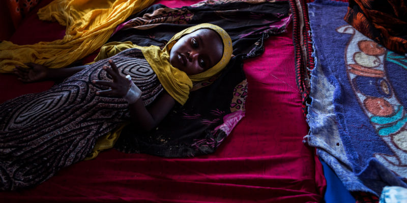 Una bambina denutrita al Garowe General Hospital di Garowe, Somalia, il 27 febbraio 2017 (Andrew Renneisen/Getty Images)
