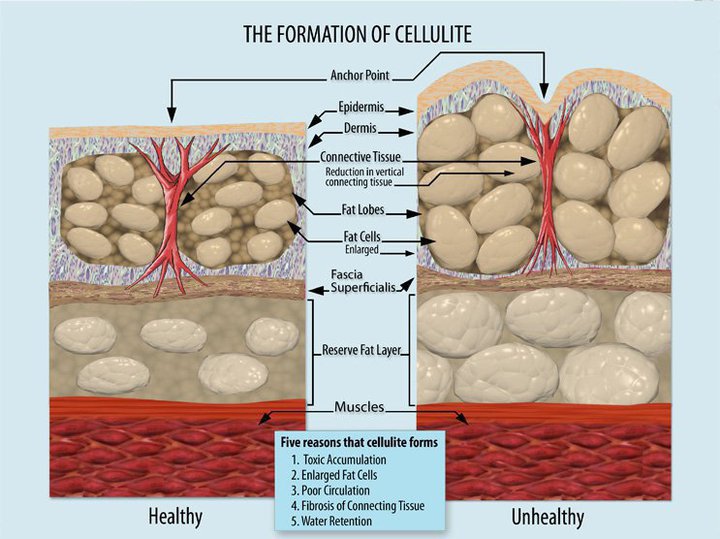 Formation_of_Cellulite
