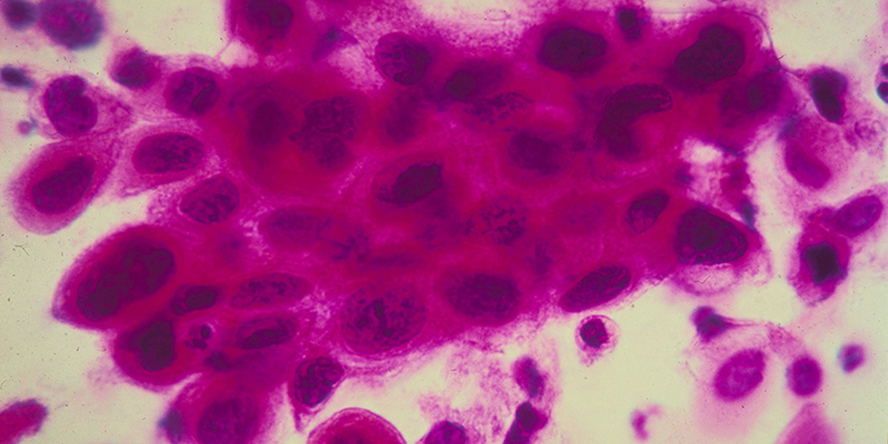 Cellule tumorali nella cervice uterina (American Cancer Society/Getty Images)