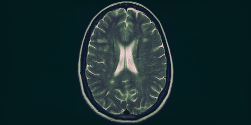 Immagine di una risonanza magnetica di un paziente con sclerosi multipla (Wikimedia)