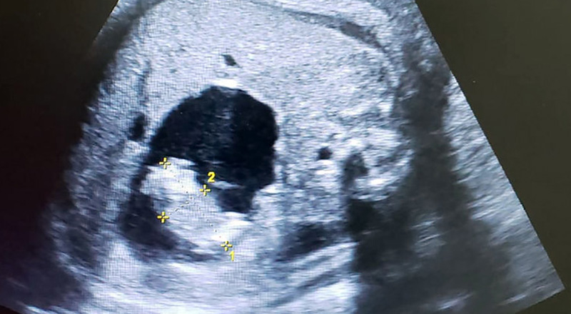 Un caso di fetus in fetu, visibile in un'ecografia (Miguel Parra-Saavedra)