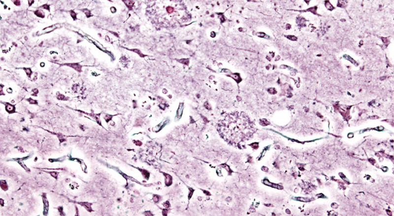 Placche amiloidi nella corteccia cerebrale di una persona affetta da morbo di Alzheimer (Wikimedia)