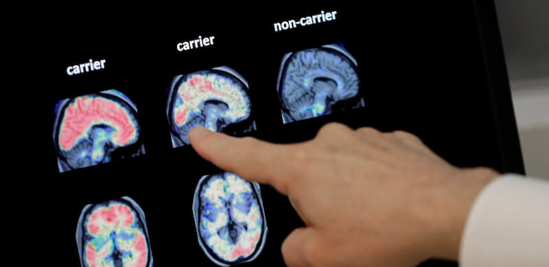 Tomografie a emissione di positroni a confronto mostrano le differenze tra il cervello di un paziente con demenza e uno sano (AP Photo/Matt York)