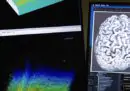 Un uomo paralizzato dalla SLA ha potuto comunicare grazie a un impianto cerebrale
