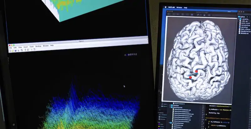 Un uomo paralizzato dalla SLA ha potuto comunicare grazie a un impianto cerebrale