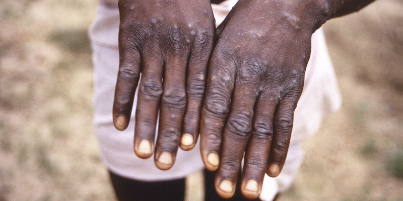 Una foto scattata nel 1997 in Repubblica Democratica del Congo alle mani di una persona malata di vaiolo delle scimmie (CDC via AP, File)