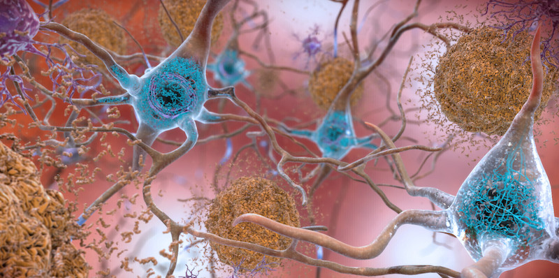 Neuroni interessati dalla degenerazione che porta all'Alzheimer, in un'elaborazione grafica (National Institute on Aging, NIH via AP)