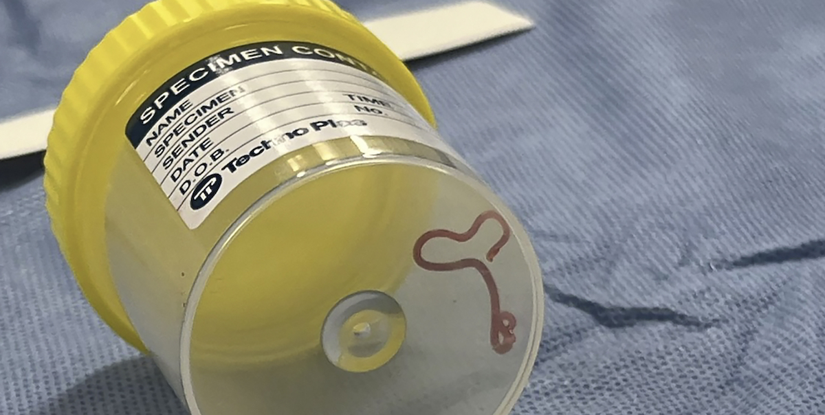 Il nematode prelevato vivo dal cervello della paziente, conservato in un contenitore dopo l'operazione (Canberra Health Services via AP)